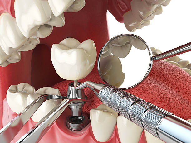 Best Emergency Tooth Extraction in Richmond, TX